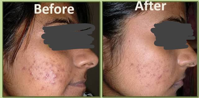 Chemical peel results